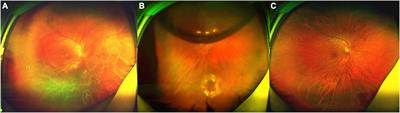 Air Tamponade for Rhegmatogenous Retinal Detachment With Inferior Breaks After 25-Gauge Pars Plana Vitrectomy: Technique and Outcome